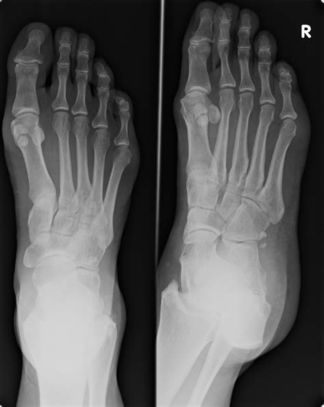 Radiology Cases: Fractured Os Peroneum, Painful Os Peroneum Syndrome (POPS)