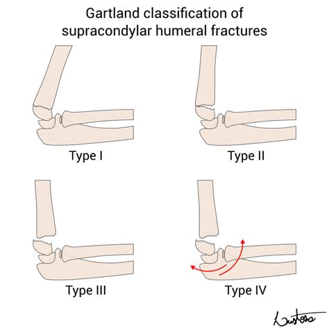 Supracondylar Fracture Types