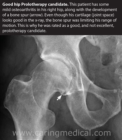 Osteoarthritis X Ray Hip