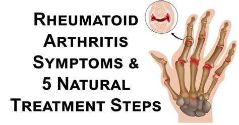 Rheumatoid Arthritis Symptoms & 5 Natural Treatment Steps - David Avocado Wolfe