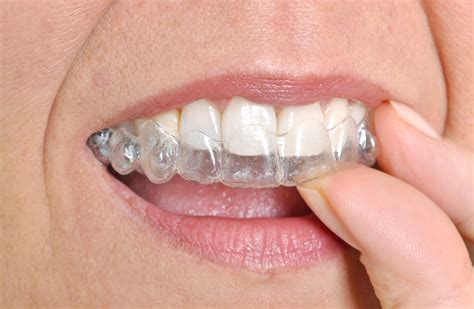 Invisalign miami, Invisalign miami fl