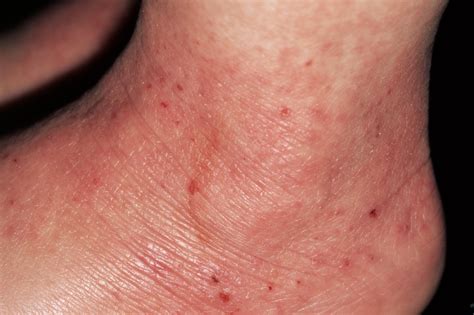 Atopic eczema - Symptoms - NHS