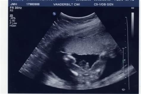 Second trimester ultrasound pictures – Artofit