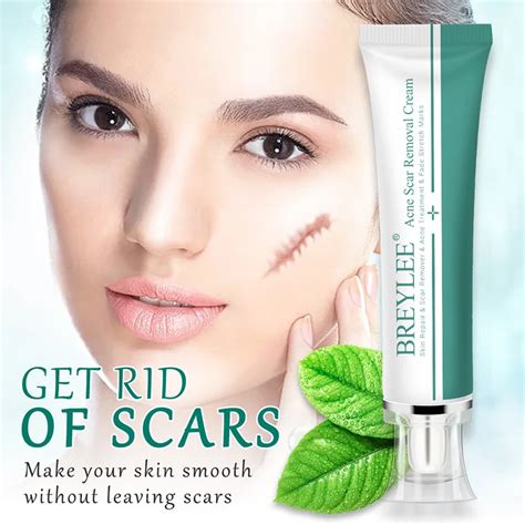 Acne Scar Removal Cream 30g Face Acne Treatment Cream Remove Stretch Markings Skin Repair Scar ...