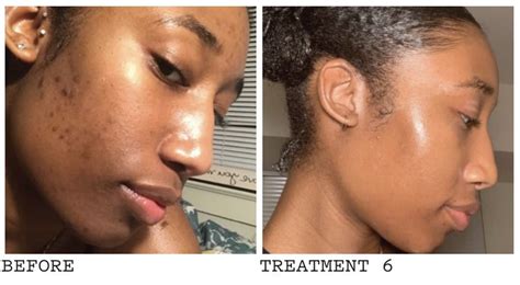 African American acne hyperpigmentation before and after | Hyperpigmentation, Clear skin ...