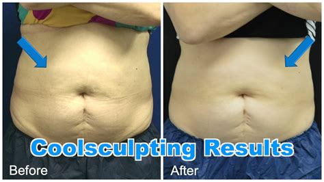 Coolsculpting Fat Freeze Before and After - YouTube