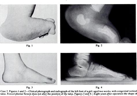 Figure 2 from The treatment of congenital vertical talus. | Semantic Scholar