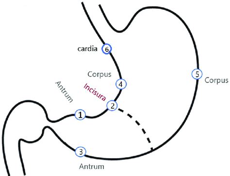 Biopsy Mapping. Biopsy Sites: 1: Antrim: Prepyloric, 2 cm of Pylorus ...