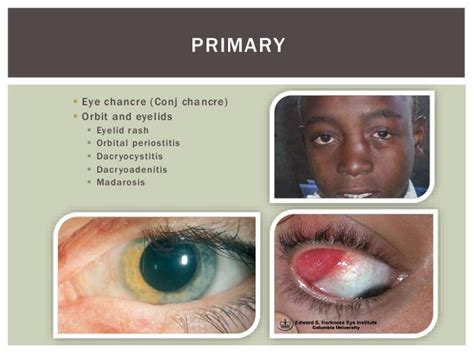 Ocular manifestations of syphilis