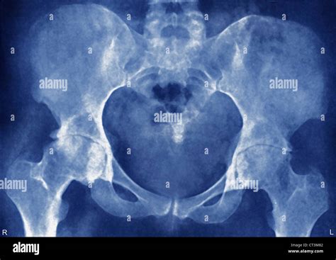 HIP OSTEOARTHRITIS, X-RAY Stock Photo - Alamy