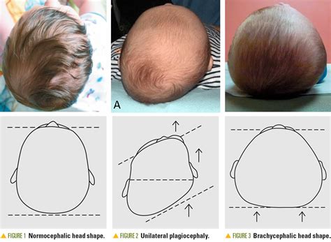 Plagiocephaly causes, symptoms, diagnosis & treatment