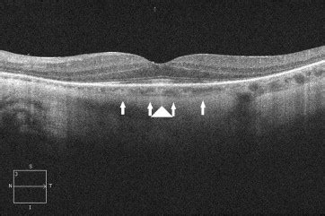 Autoimmune Retinopathy | Ento Key