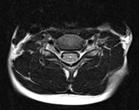 MRI Spine - Paediatic MRI Series