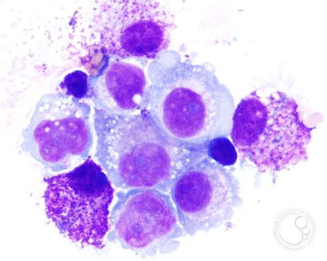 Pleural Fluid Mast Cells - 6.