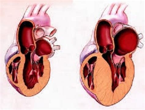 Left Ventricular Hypertrophy: Causes, Picture, Symptoms, And Treatment