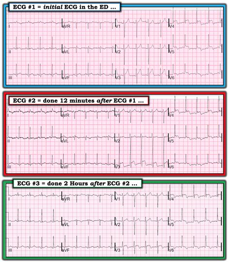 Dr. Smith's ECG Blog: What does this ECG with significant ST Elevation represent?