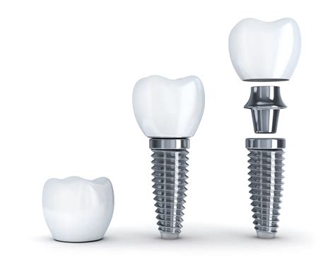 Where is a Dentist Near Me for Dental Implants? - JL Dental Blog