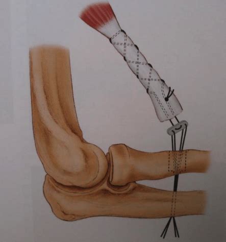 Distal Biceps Rupture | Distal Biceps Repair | Dr. Christopher S Ahmad