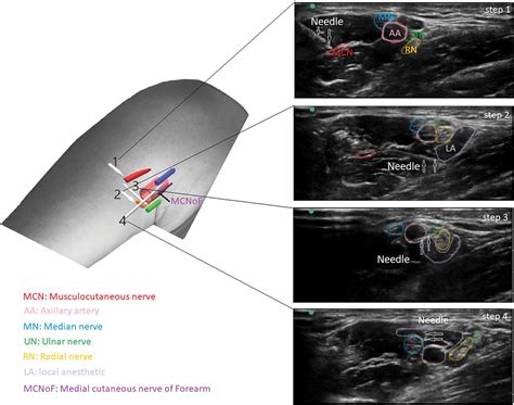 Axillary Block - OpenAnesthesia