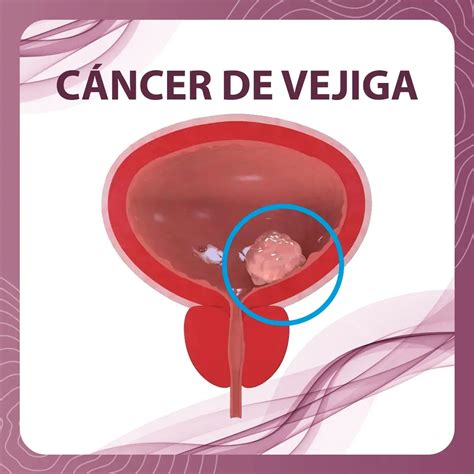 Clasificación Del Cáncer De Vejiga