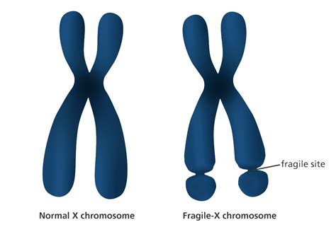 Epigenetics May Provide Relief for Fragile X Syndrome and Intellectual ...