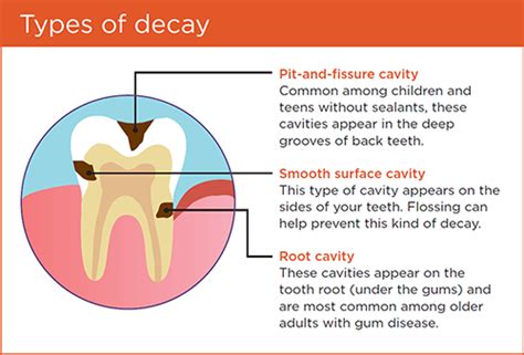 The truth about adult cavities | Delta Dental