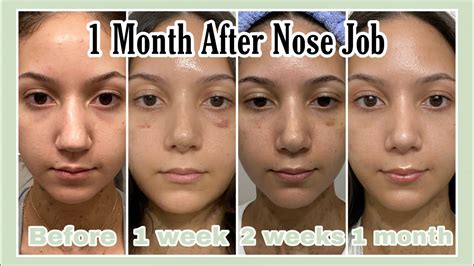 1 Month Rhinoplasty Update *With Pictures* - YouTube