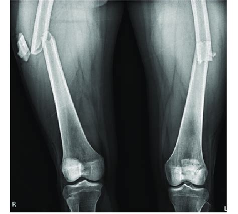 Plain radiograph showing bilateral femur shaft fracture with comminuted... | Download Scientific ...