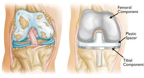 MLD and total knee replacement