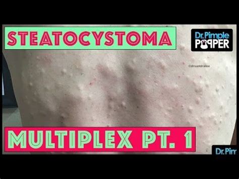 Watch Dr. Pimple Popper Pop Dozens of Cysts on a Man with Steatocystoma ...