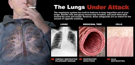 Smoking Is the Major Risk Factor for Non-Small Cell Lung Cancer - StoryMD