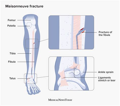 Maisonneuve fracture: Anatomy, treatment, and recovery