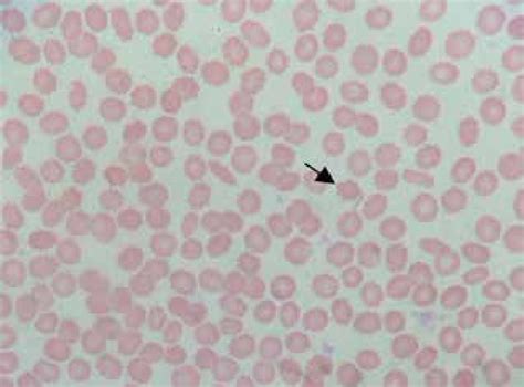 Blood smear shows numerous acanthocytes. | Download Scientific Diagram