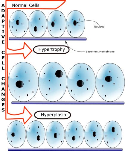 Hyperplasia_vs_Hypertrophy | b-reddy.org