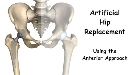 Benefits Of Hip Replacement Using The Direct Anterior Approach