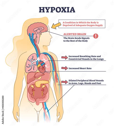 Hypoxia condition as lack of oxygen in brain cells or tissues outline ...