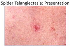 Describe a Spider Telangiectasia