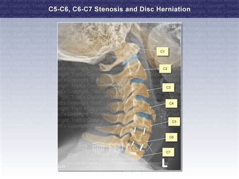 C5-C6, C6-C7 Stenosis and Disc Herniation: Lateral View with Neck...