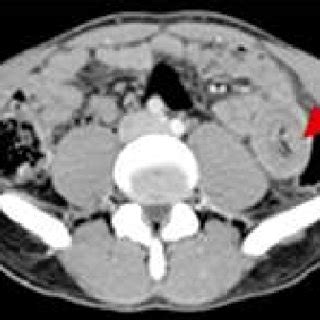 -Contrast-enhanced axial CT images revealed enlarged spleen with a ...