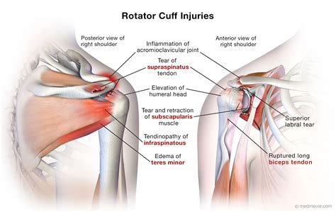 Rotator Cuff Injury