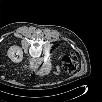 CT guided percutaneous needle biopsy of a retroperitoneal mass ...