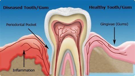 Gum Disease: Symptoms, Cause and Treatment.