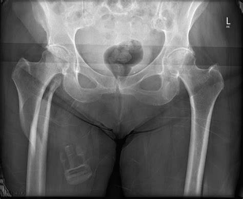 Hip Fractures & Trauma - Brisbane Hip Clinic Australia