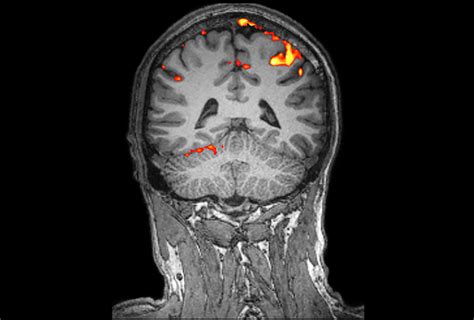 Brain scans connect autism with schizophrenia, depression | Spectrum ...