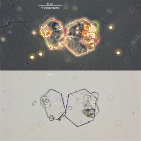 Urine Sediment of the Month: Cystine Crystals - Renal Fellow Network