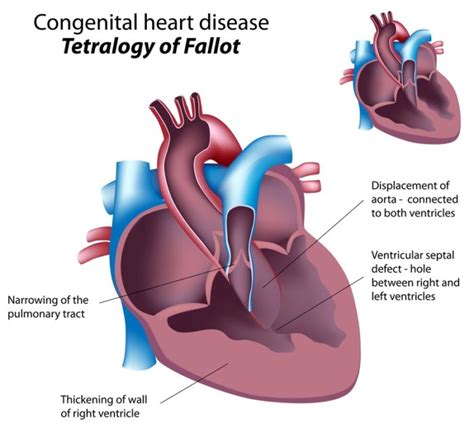 Congenital Heart Disease: How It Can Affect Us in Adulthood - University Health News