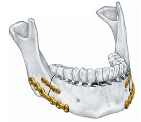 Maxillofacial Trauma: Mandibular Fractures