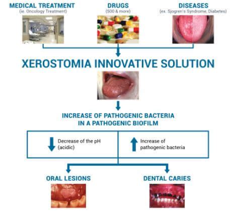 Xerostomia Definition Of Xerostomia | Hot Sex Picture