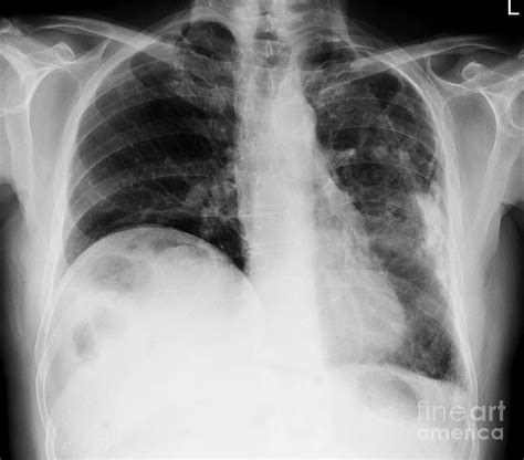 Lung Disease, X-ray #1 Photograph by Science Photo Library - Fine Art ...