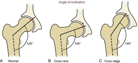 The proximal femur is shown: Normal angle of inclination (A), coxa vara ...